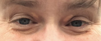 For højt kolesterol start juli